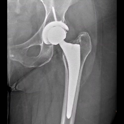 X-ray of anterior hip replacement