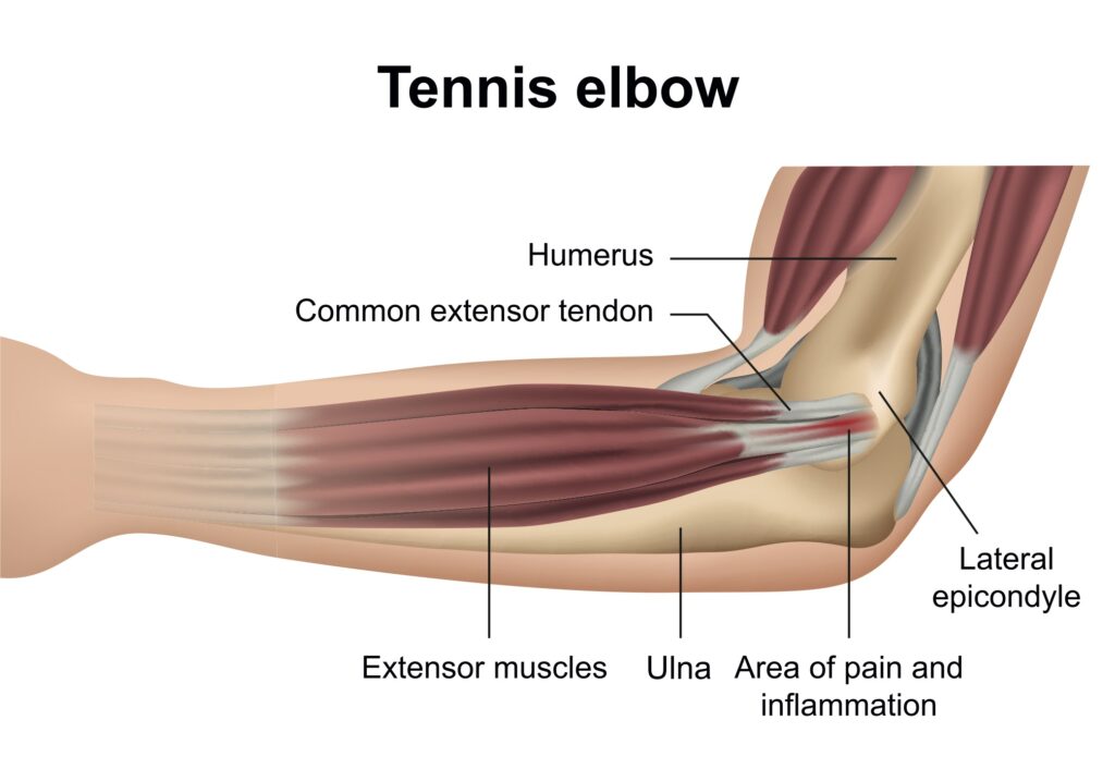 Tennis elbow anatomy