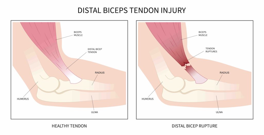 Distal biceps injury vs healthy biceps tendon