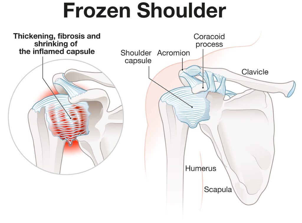 frozen shoulder anatomy 