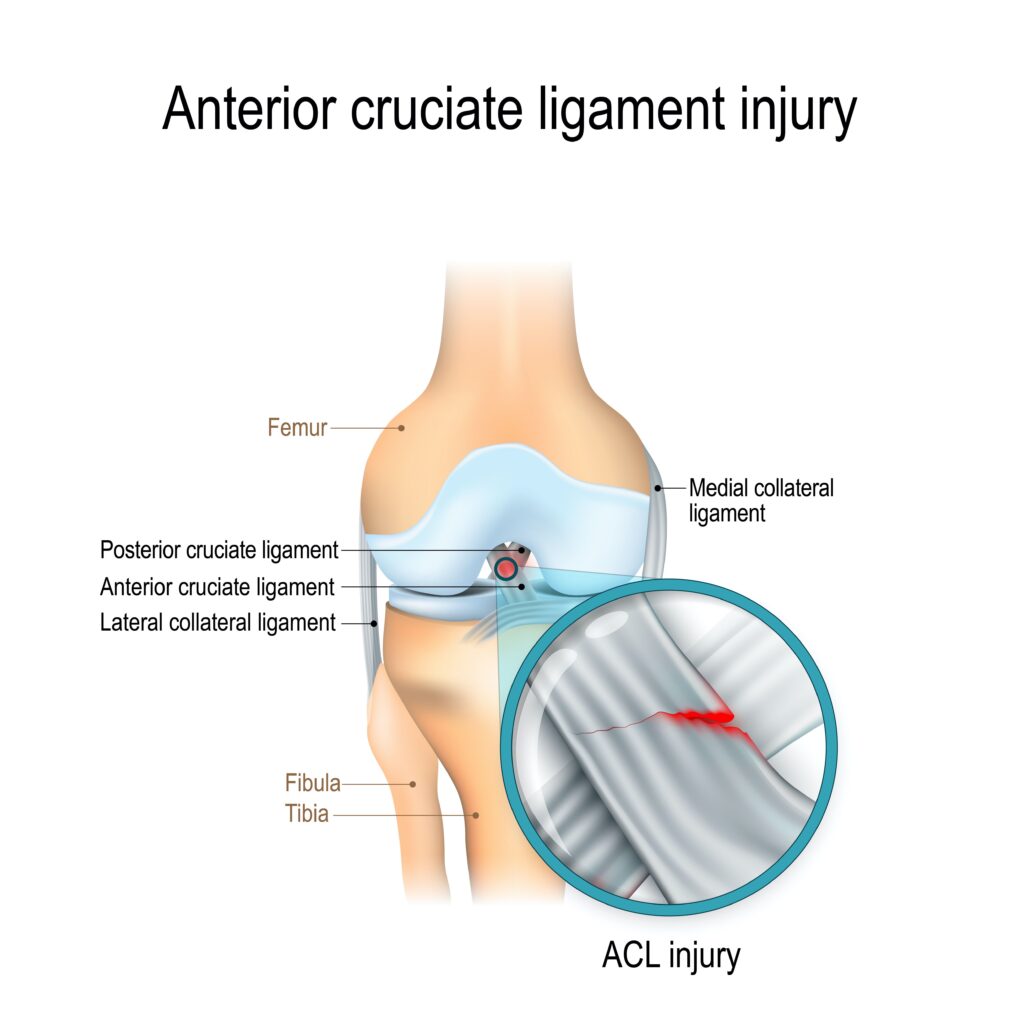 Anatomy of ACL injury for ACL reconstruction surgery