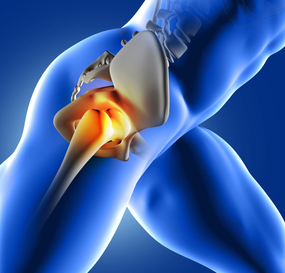 anterior-hip-replacement-in-modesto-ca-dr-eric-giang