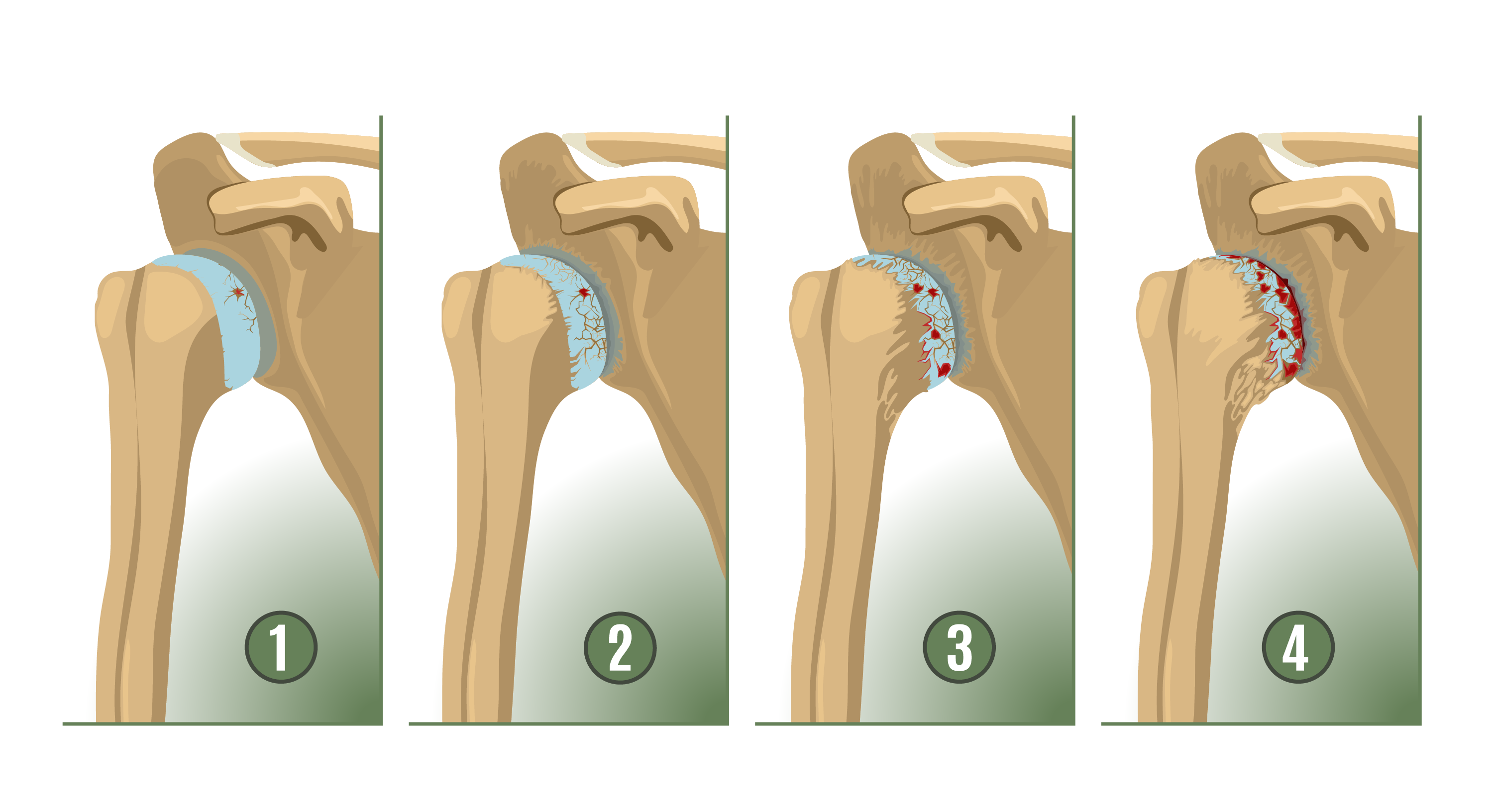 What does shoulder arthritis feel like? Anatomical graphic of shoulder arthritis