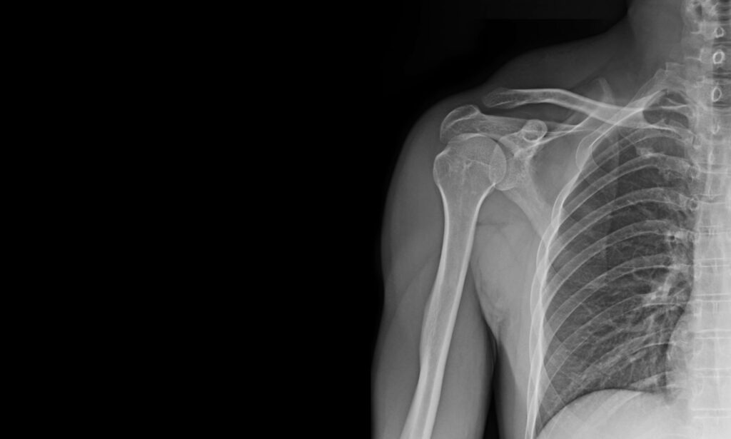 X-ray of Shoulder, Arthritis pain in your shoulder