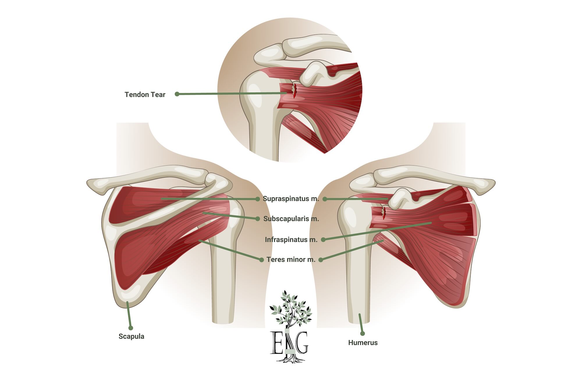 Anatomy of a healthy rotator cuff and a torn rotator cuff