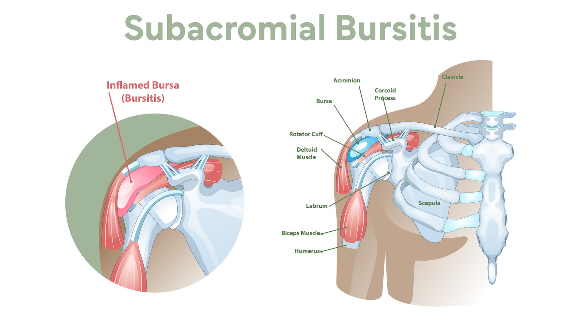 Anatomical Graphic of Subacromial Bursitis