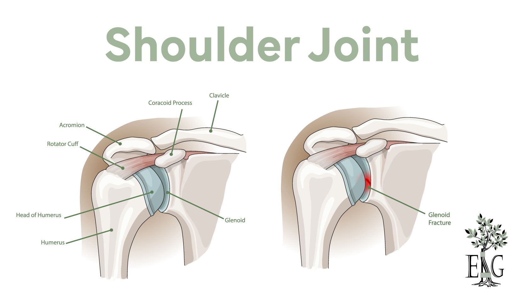 Anatomical Graphic of the Shoulder Joint and Understanding Glenoid Fractures