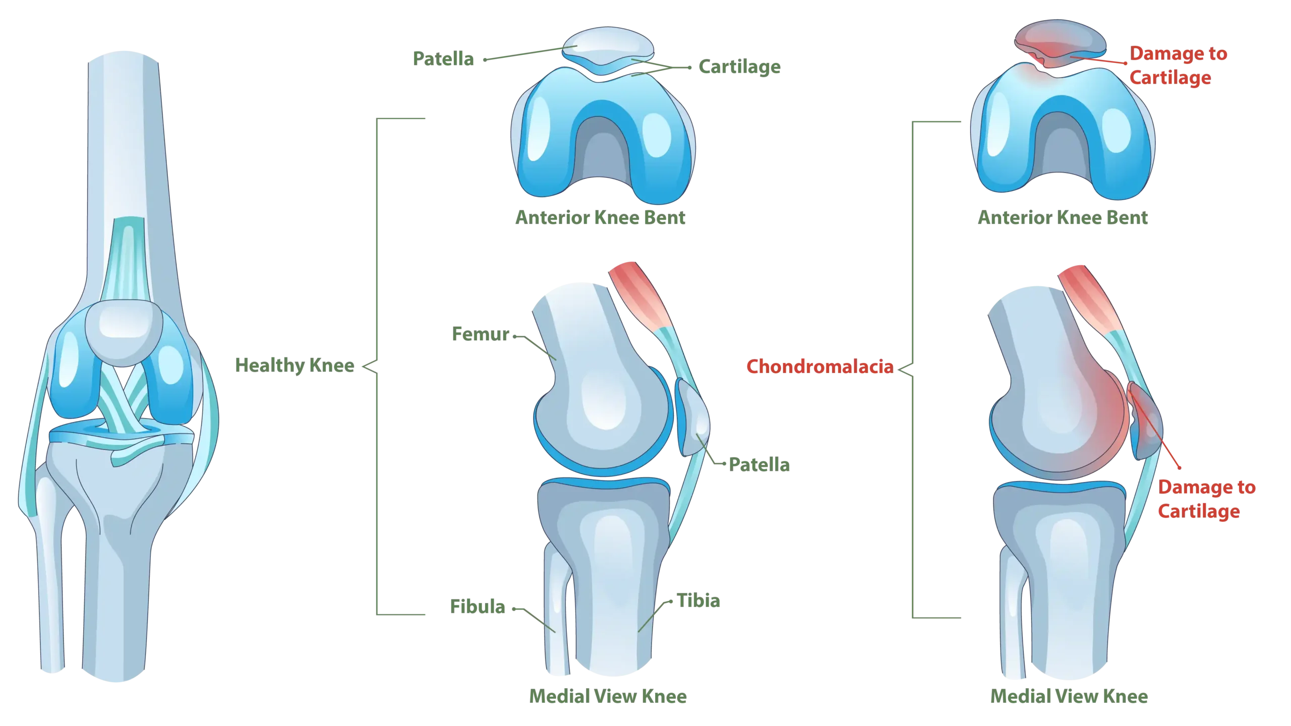 Anatomy of the Chondromalacia of Patella