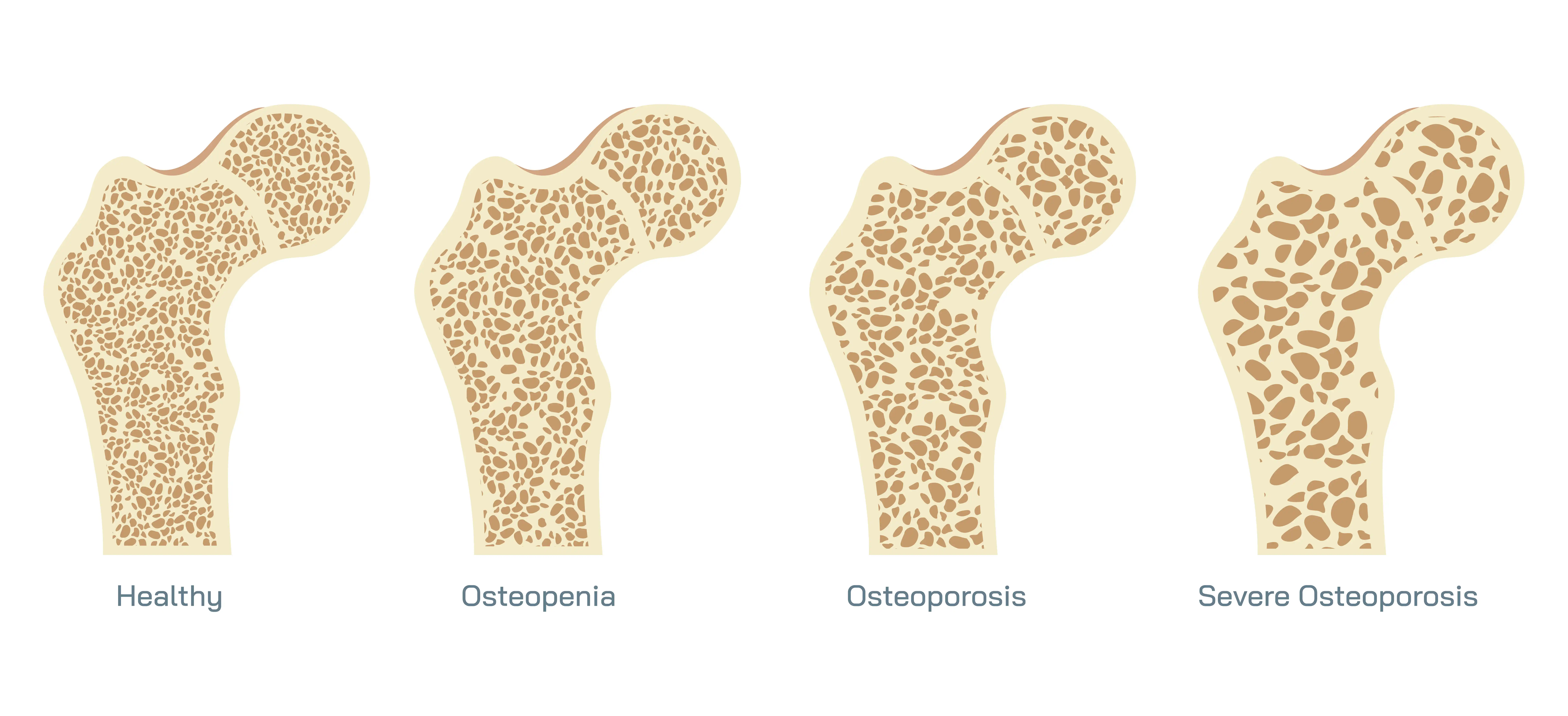 Anatomical Graphic Osteoporosis