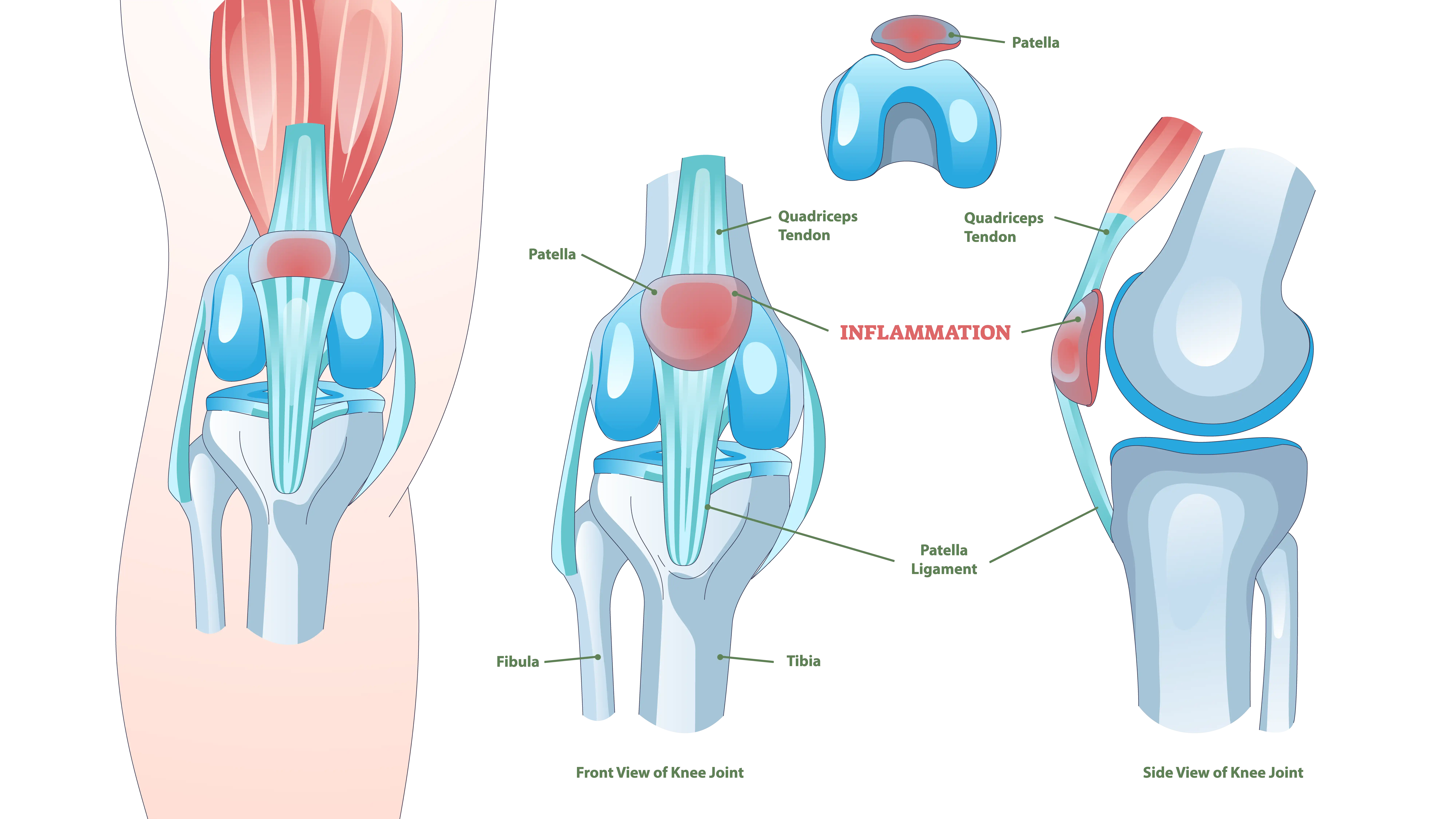 Anatomy of Runner Knee
