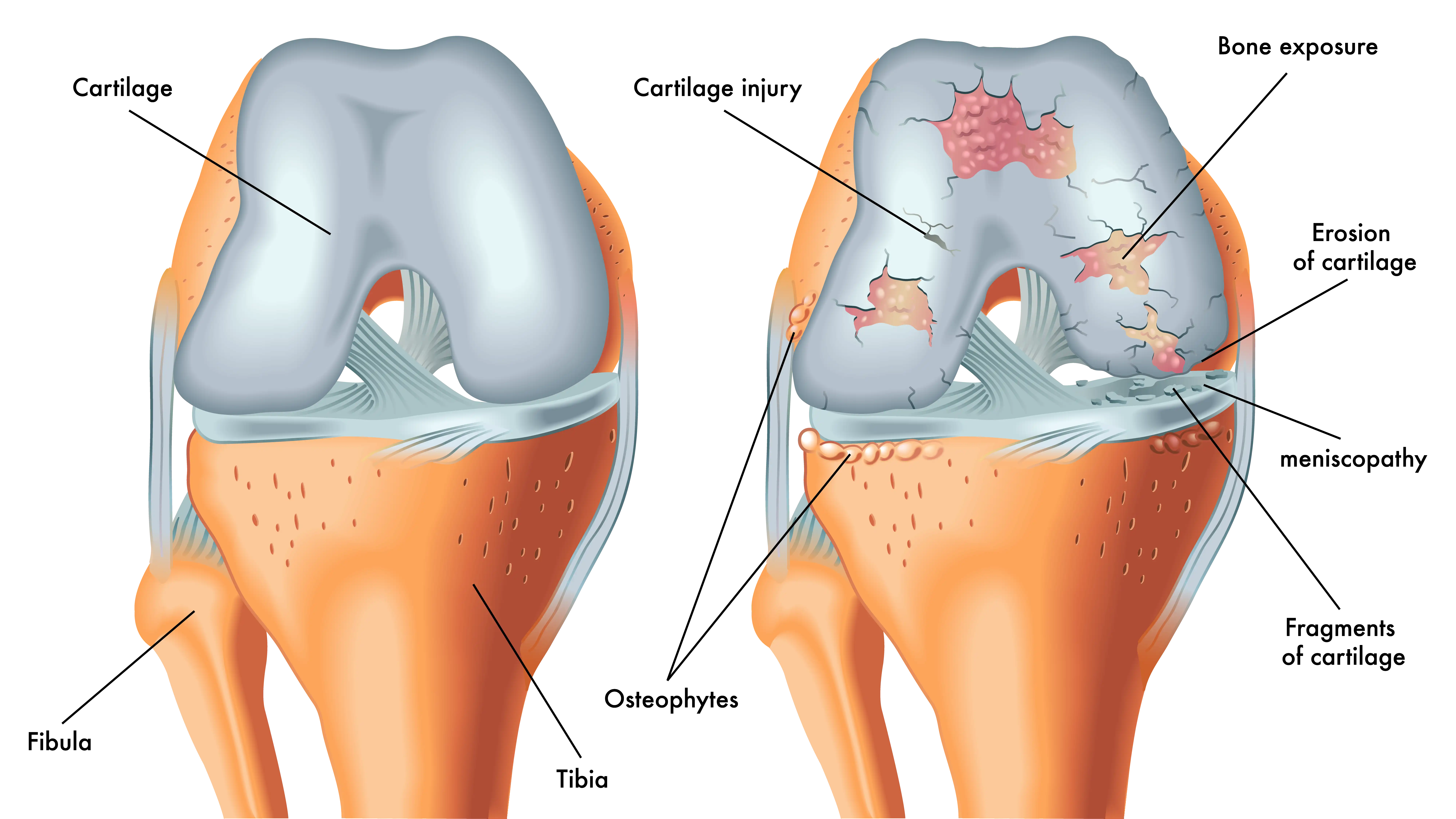 Understanding Knee Replacement Surgery