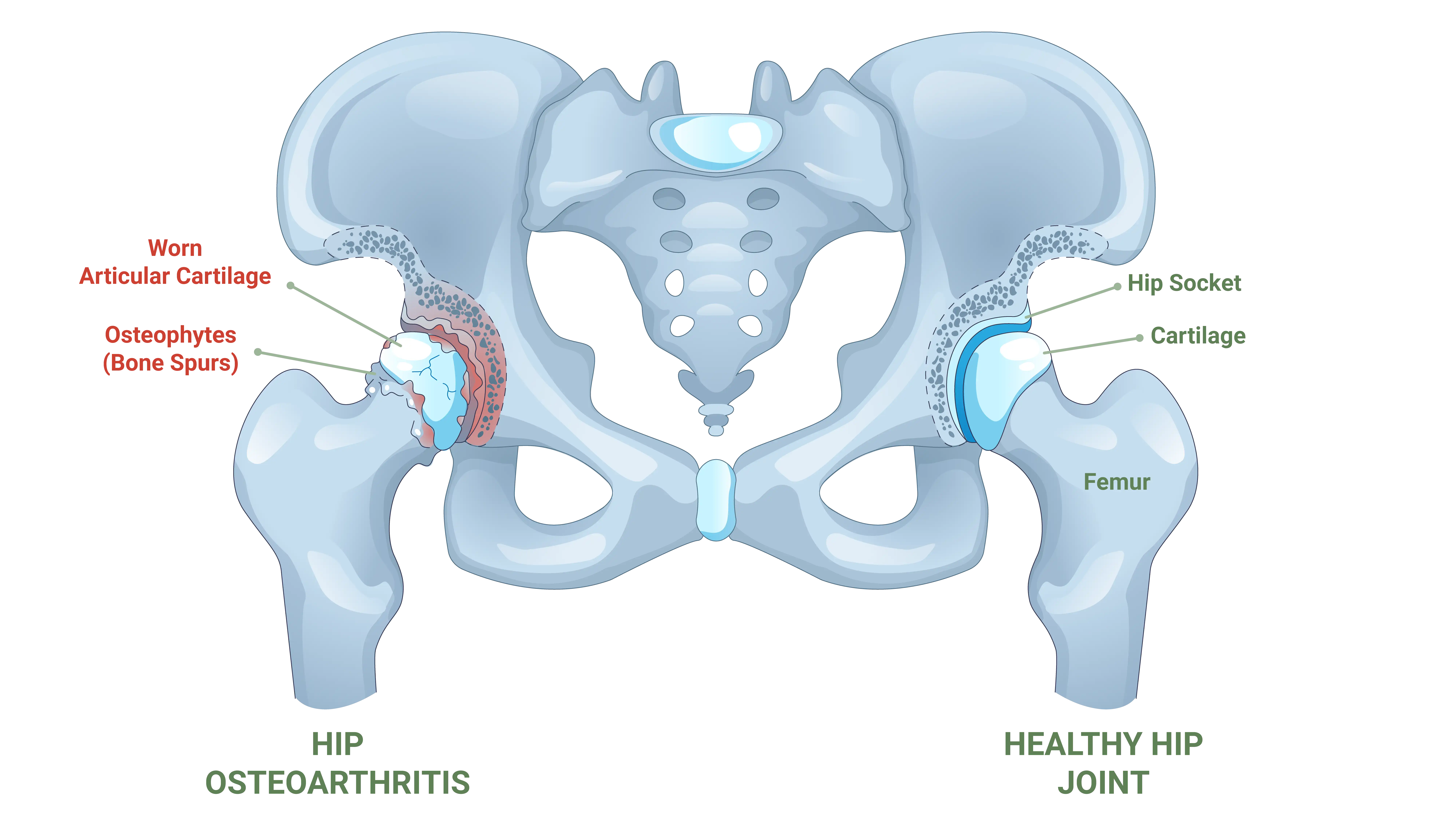 Anatomical Graphic of Hip Arthritis