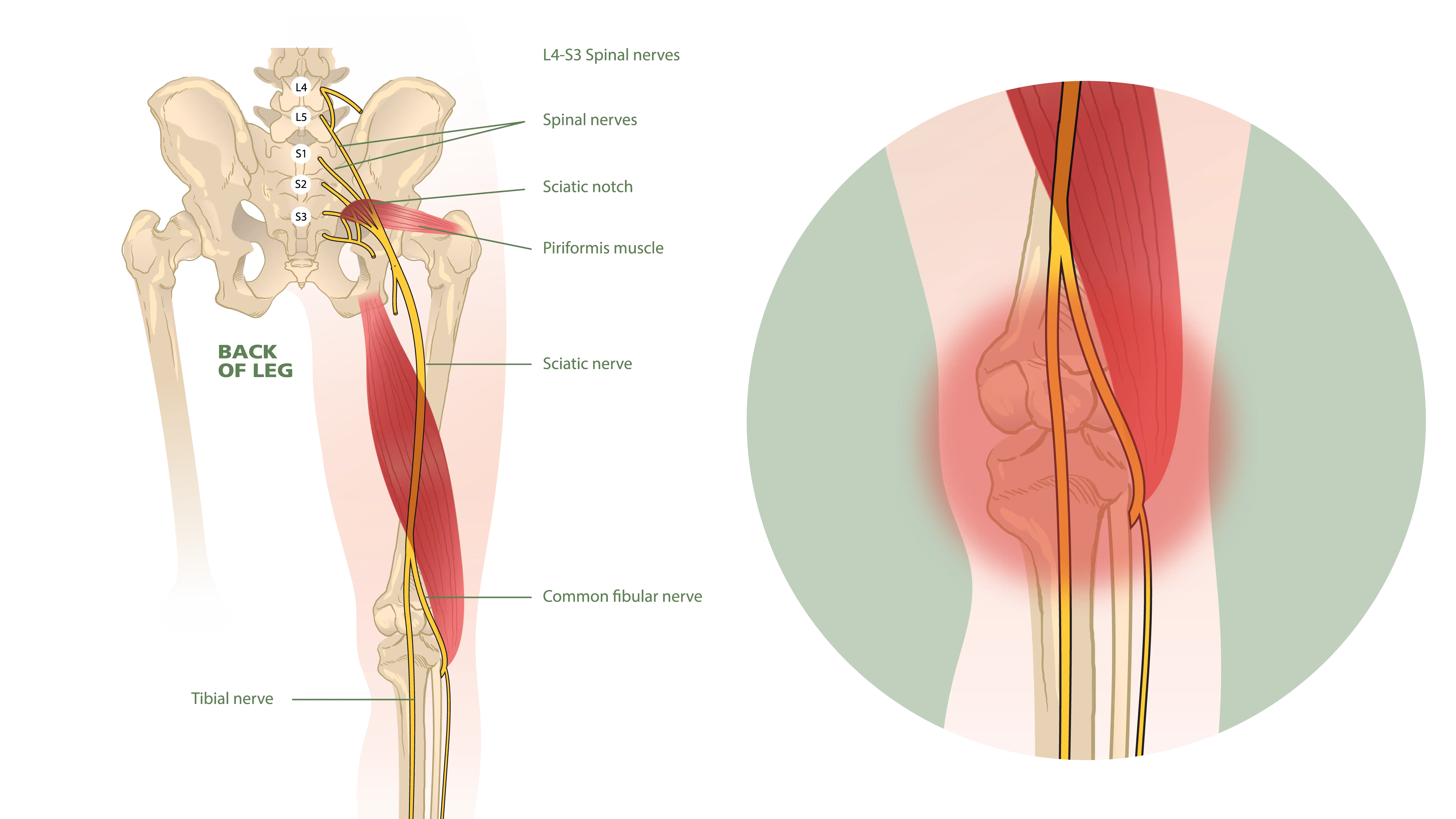 Anatomical Graphic of Sciatica that can cause knee pain