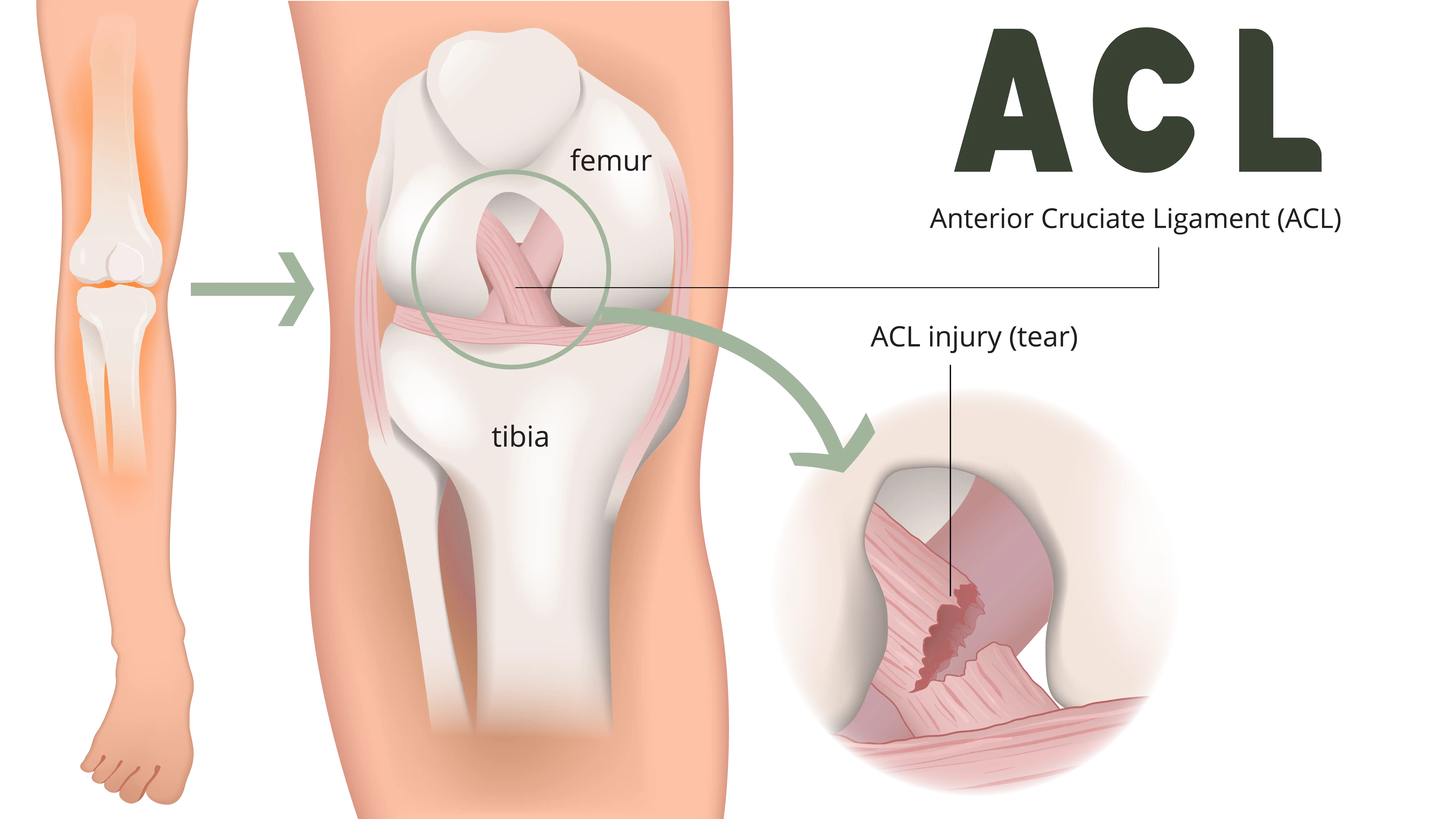 Anatomical Graphic of ACL Tear