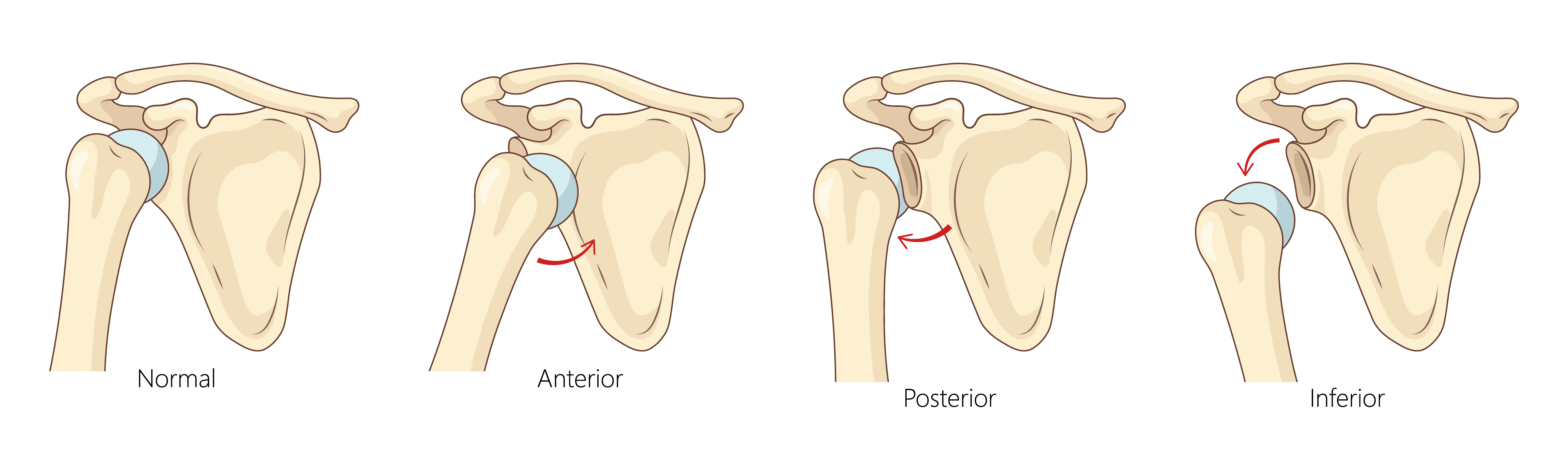 Anatomical Graphic of Shoulder Dislocation