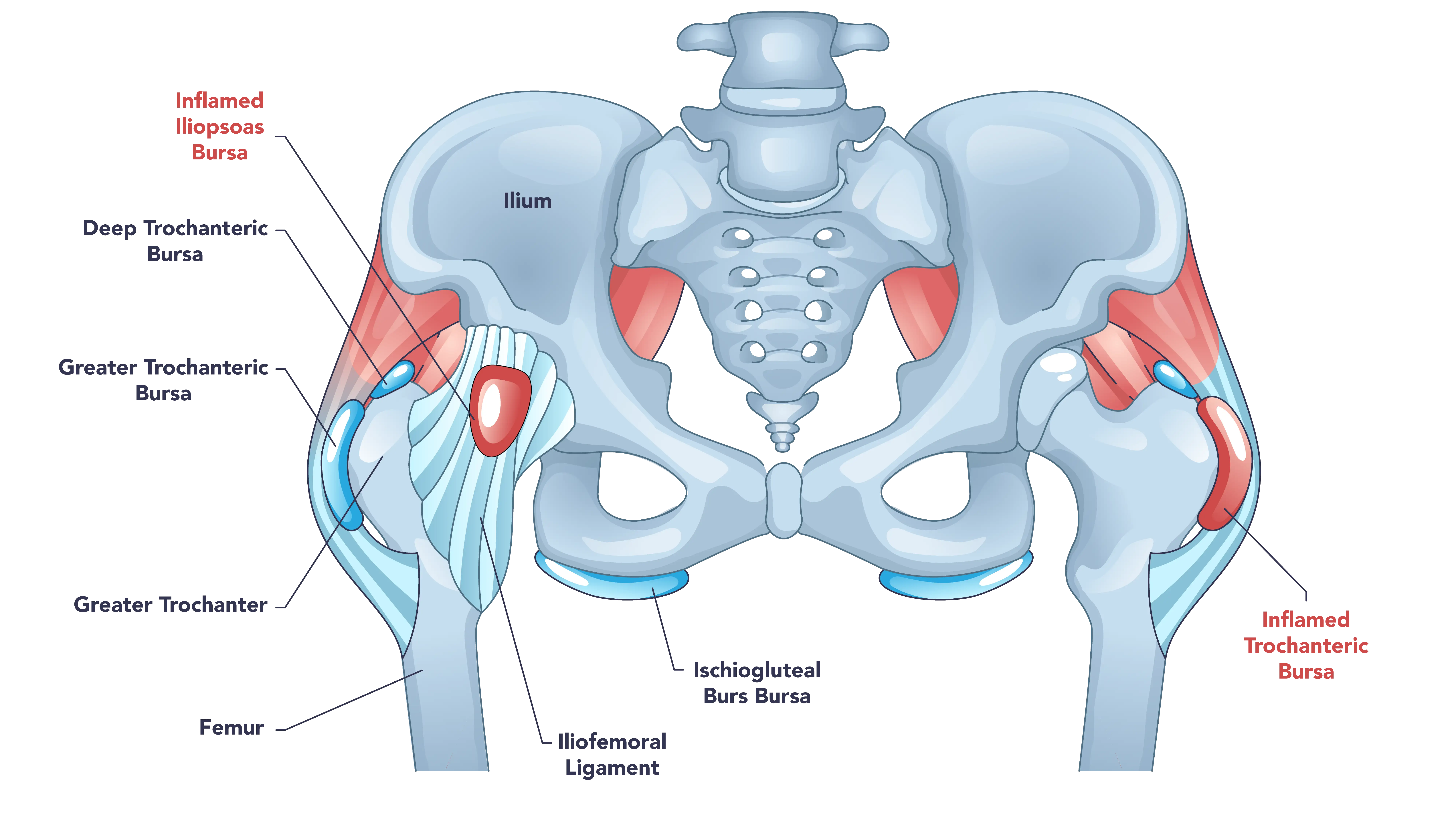 Anatomical Graphic of Hip Bursitis
