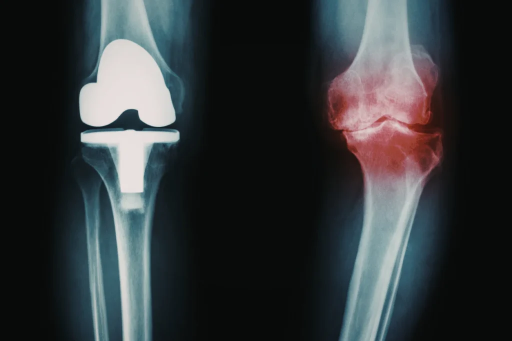 Xray of Knee osteoarthritis