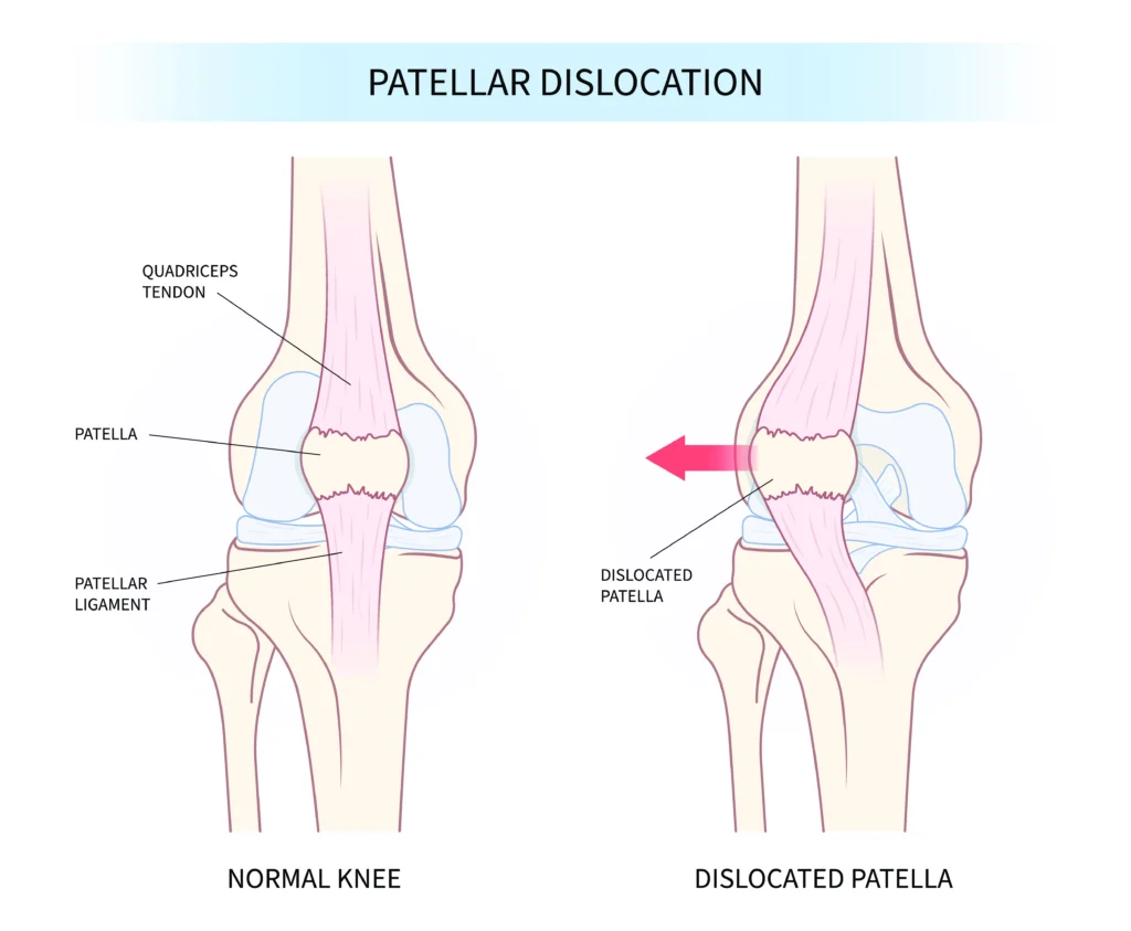 patellar dislocation diagram patellar dislocation diagram, comparison between regular and injured kneecaps