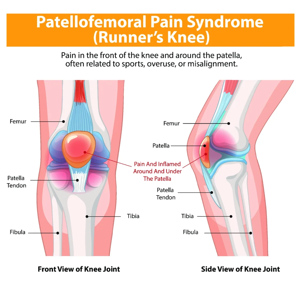 Runners knee anatomical diagram
