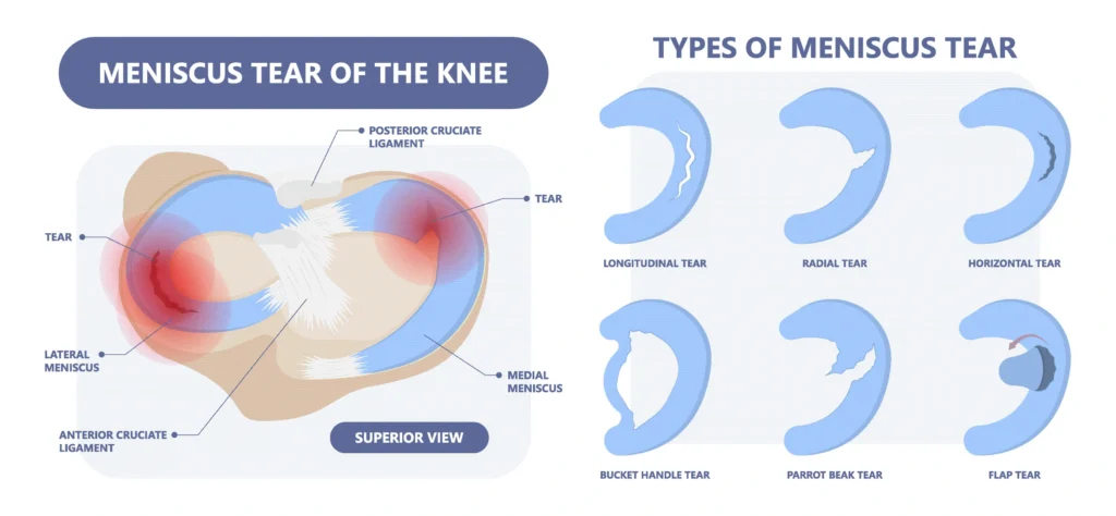 meniscus_tear_knee_diagram Knee meniscus tear infographic with anatomical labels and six meniscus tear type illustrations.