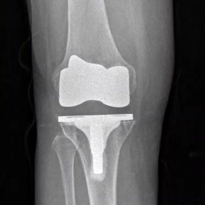8756745434gwr Robotic knee replacement implant x-ray