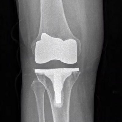 Robotic knee replacement implant x-ray